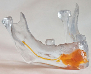 Moulage dentaire réalisé avec le matériau VisiJet Clear à l’aide d’une imprimante ProJet 6000. (Source : 3D Systems)